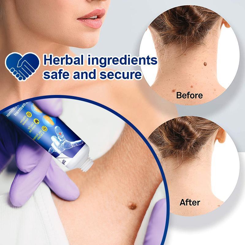 Wart and Tag Remover Cream