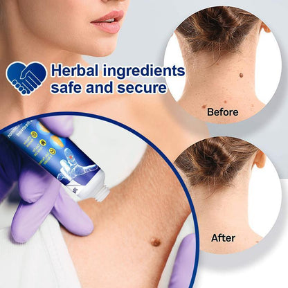 Wart and Tag Remover Cream